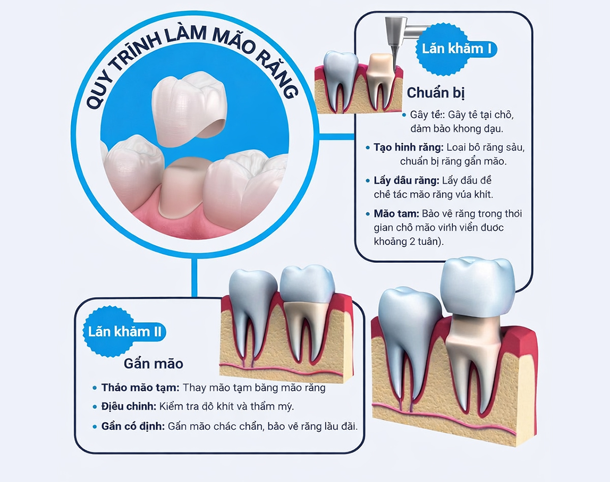 dich-vu-boc-rang-su-5 https://mastersmile.vn/wp-content/uploads/2026/01/dich-vu-boc-rang-su-5.jpg