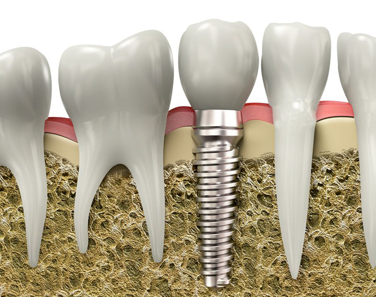 dich-vu-cay-rang-implant-1