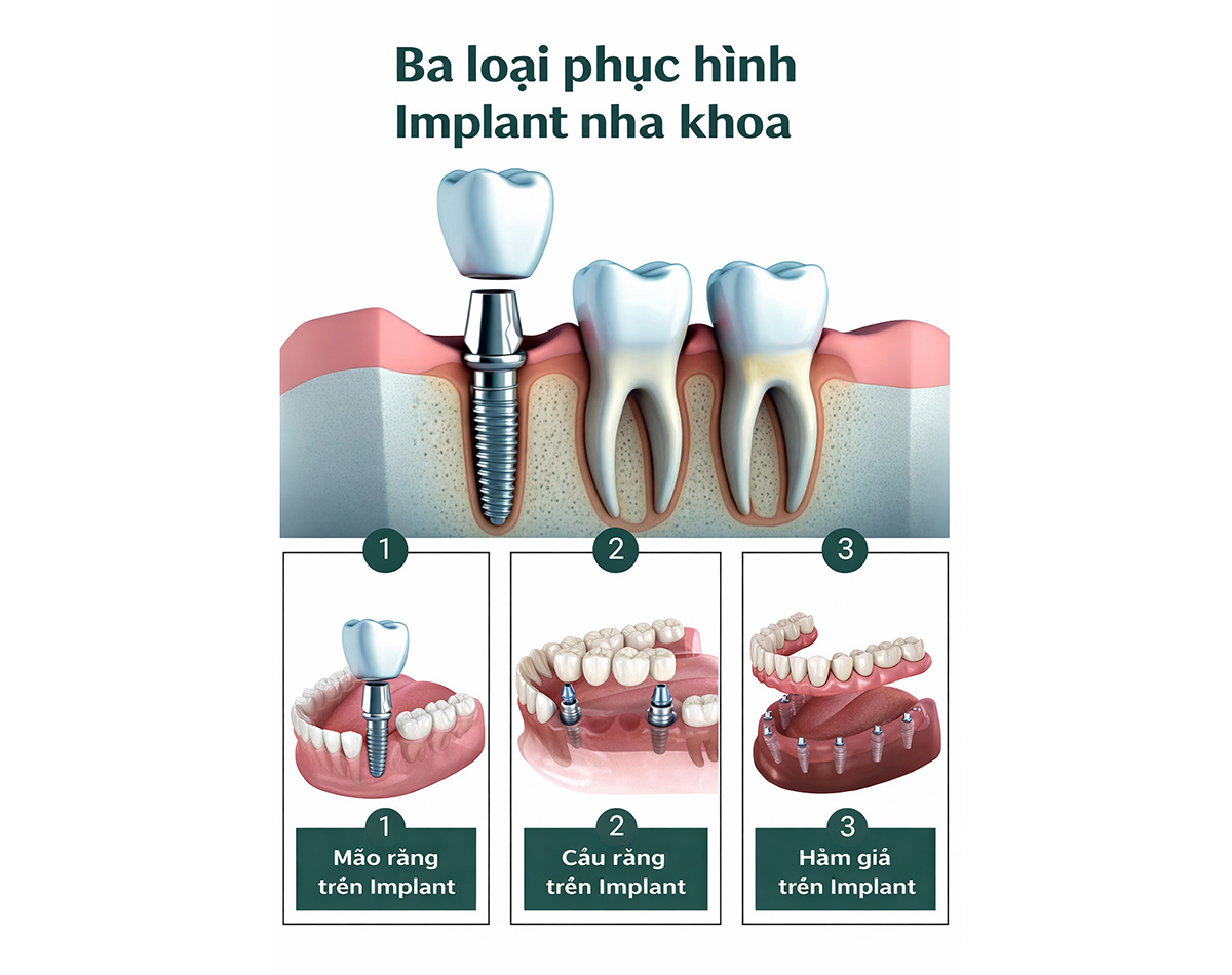 https://mastersmile.vn/wp-content/uploads/2026/01/dich-vu-cay-rang-implant-3.jpg