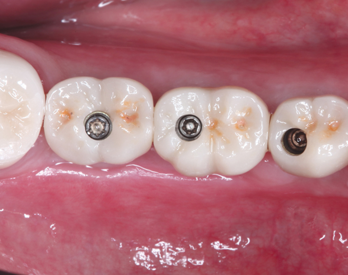 dich-vu-cay-rang-implant-5