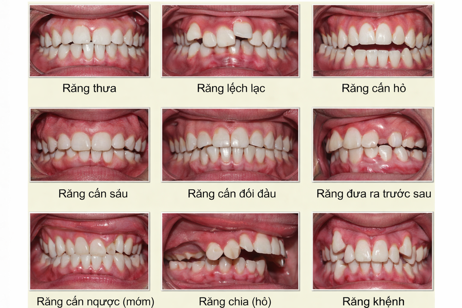 nieng-rang-2 https://mastersmile.vn/wp-content/uploads/2026/02/nieng-rang-2.png