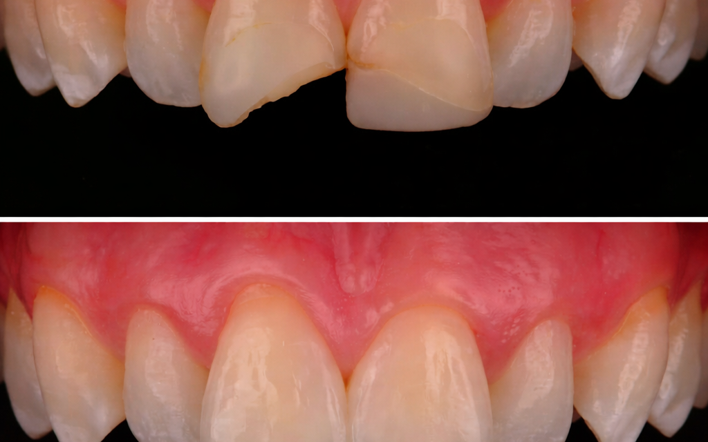 Răng cửa bị sâu có trám được không? Bác sĩ giải đáp chi tiết từng trường hợp