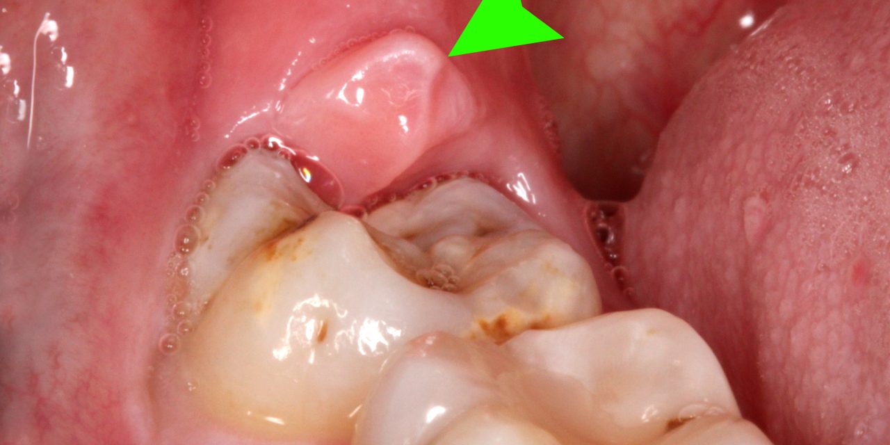Răng khôn bị sâu có trám được không? Bác sĩ giải đáp nên giữ hay nhổ