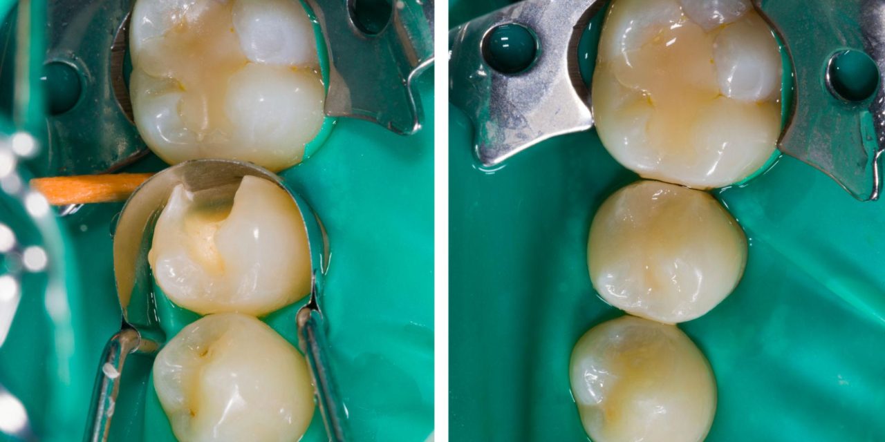 Trám răng bao lâu thì được ăn? Bác sĩ giải thích rõ theo từng loại trám