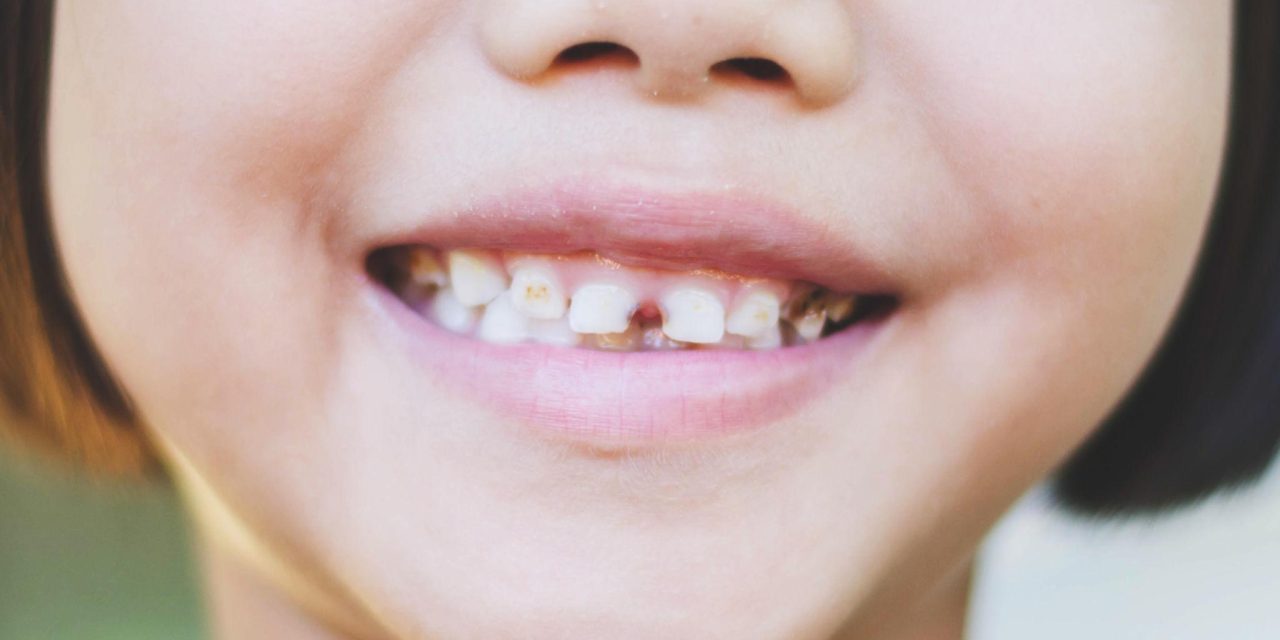Trẻ bị sâu răng có nên trám không? Bác sĩ giải thích rõ để phụ huynh không chủ quan
