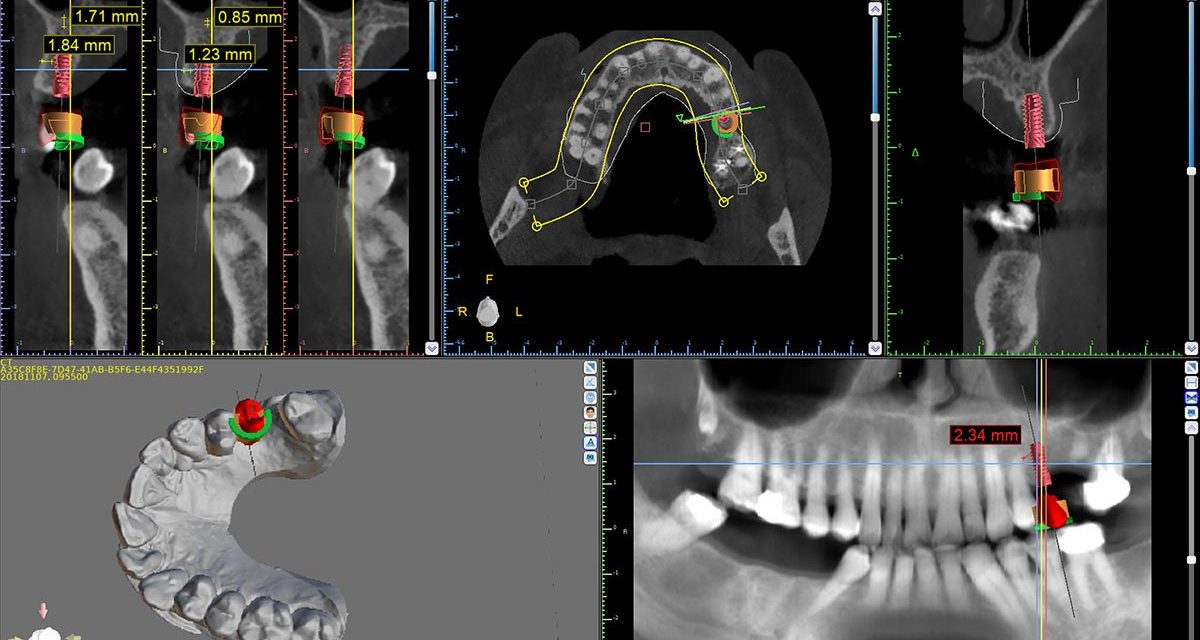 Các bước cấy ghép implant – Quy trình chuẩn dưới góc nhìn bác sĩ nha khoa