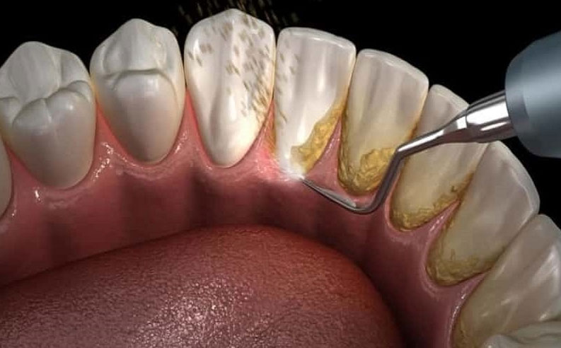 Cạo vôi răng có chảy máu không? Bác sĩ nha khoa giải thích chi tiết