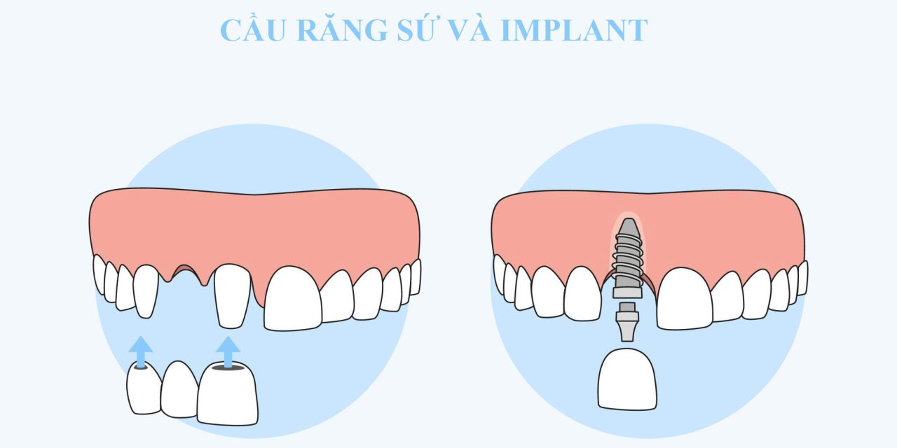 Cầu răng sứ và Implant – So sánh chi tiết để lựa chọn giải pháp phục hình phù hợp