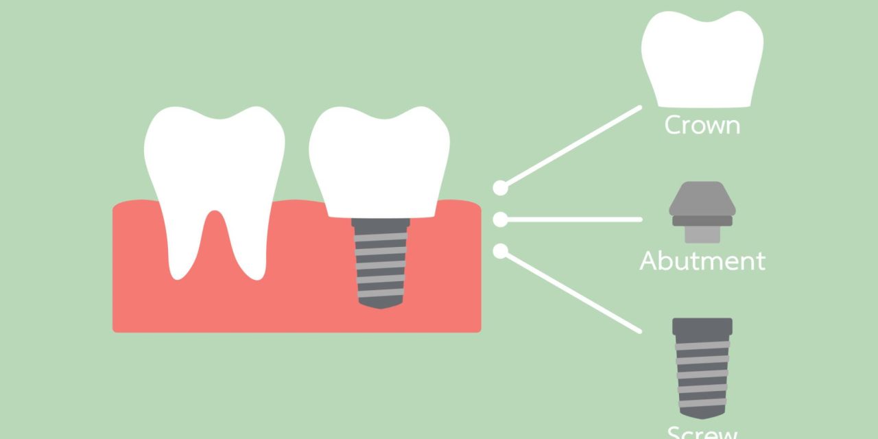Cấy ghép implant ở đâu tốt nhất – Bác sĩ nha khoa giải đáp toàn diện