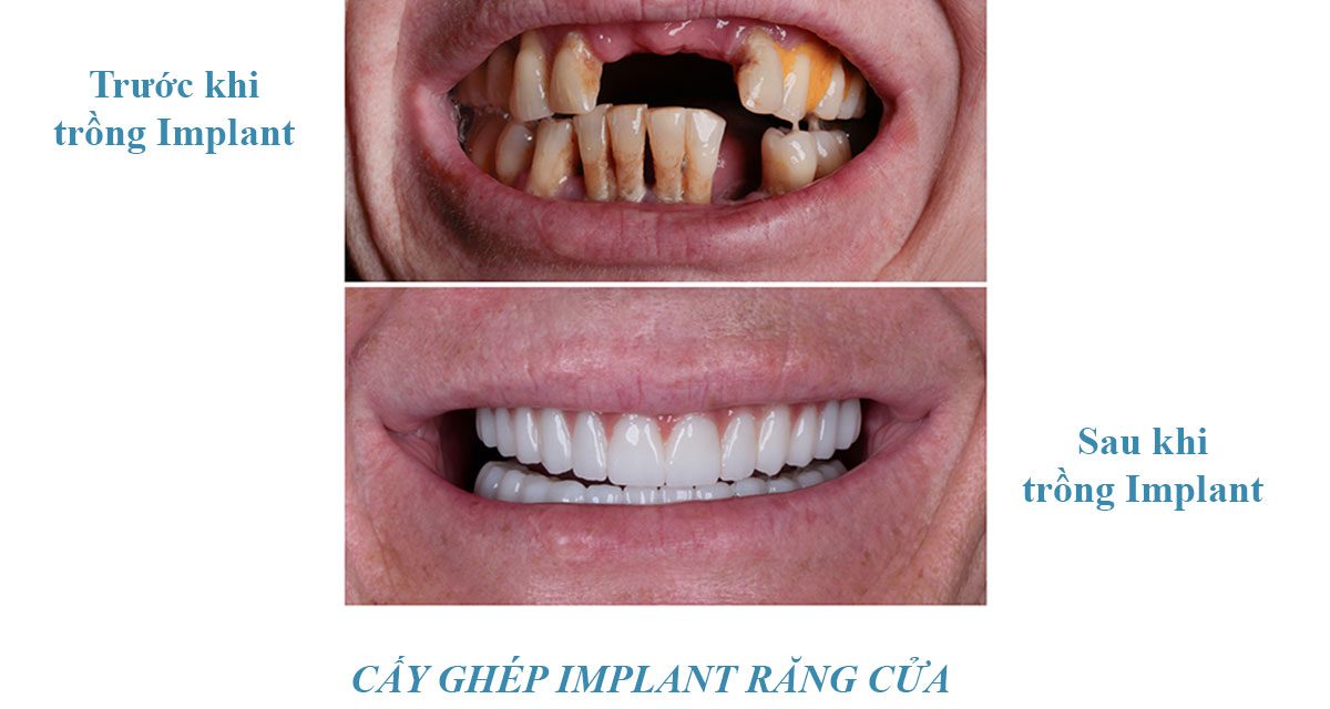 Cấy ghép implant răng cửa – Phân tích kỹ lưỡng từ góc nhìn bác sĩ nha khoa