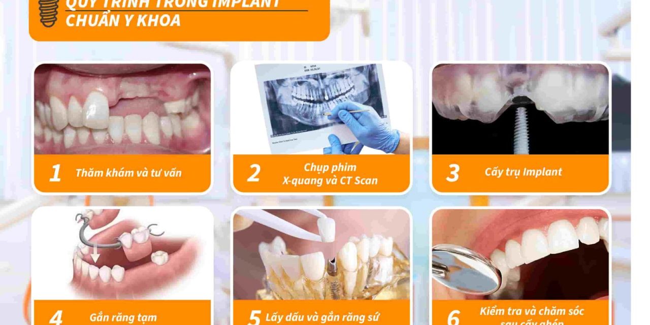 Quy trình trồng răng Implant mất bao lâu? Thời gian chi tiết từng giai đoạn