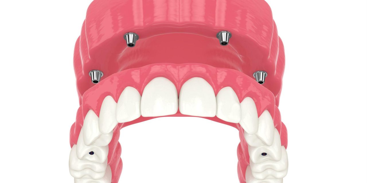 Cấy implant toàn hàm – Giải pháp phục hồi răng mất toàn bộ từ góc nhìn bác sĩ