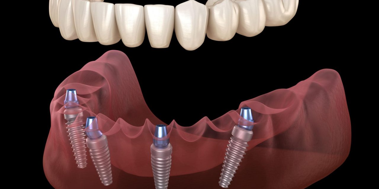 Cấy ghép Implant là gì? Giải pháp phục hình răng mất hiện đại và bền vững