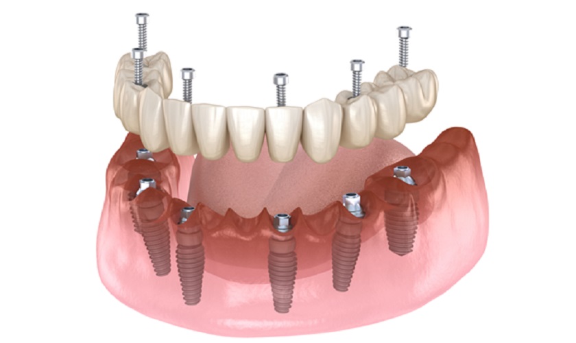 Kỹ thuật trồng răng implant – Phân tích chuyên sâu từ góc nhìn bác sĩ nha khoa
