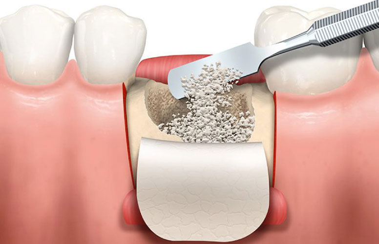 Ghép xương trong cấy ghép Implant – Giải pháp quan trọng khi xương hàm không đủ