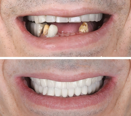 Mất răng lâu năm có trồng Implant được không? Bác sĩ giải đáp và hướng điều trị