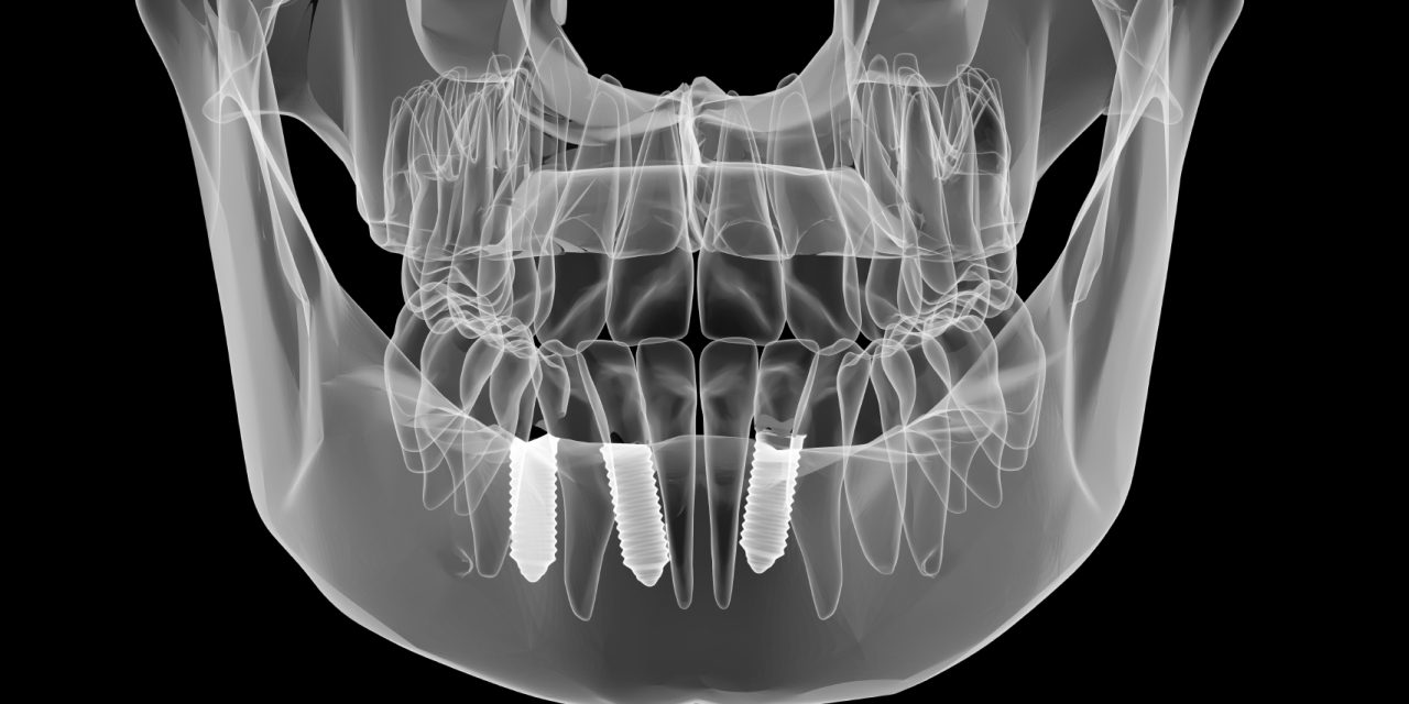 Sau khi nhổ răng bao lâu thì trồng implant – Bác sĩ giải đáp theo từng trường hợp