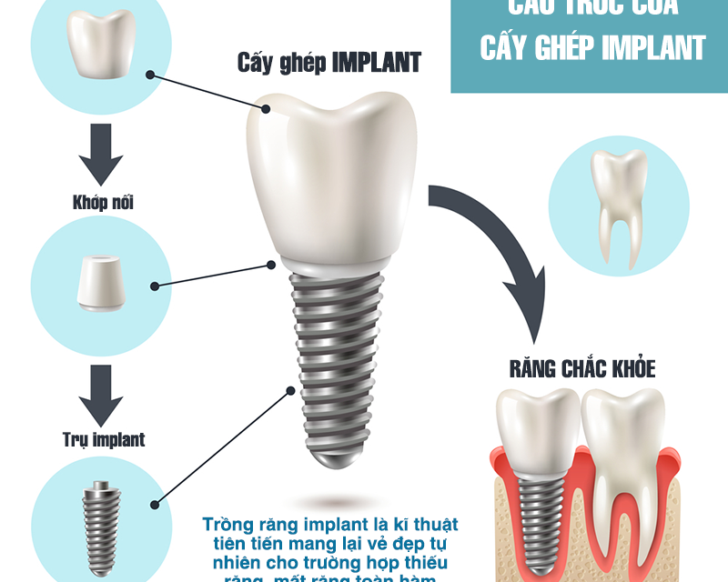 So sánh các loại trụ implant – Giải thích chuyên sâu từ bác sĩ nha khoa