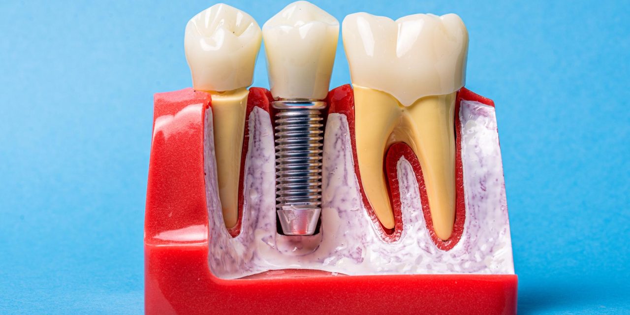 Trồng răng implant mất bao lâu – Giải đáp chi tiết từ bác sĩ nha khoa